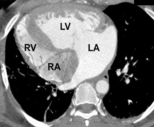 aortic valve, confirming that left ventricle is a morphologic left ventricle.