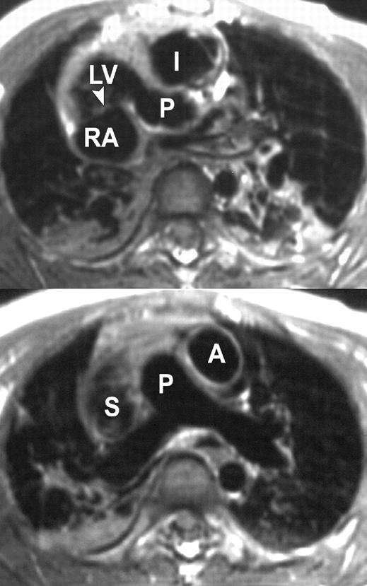 Situs solitus with L-loop ventricles is a discordant L-bulboventricular loop, and, with the addition of the associated L- TGA, results in congenitally corrected TGA (Fig. 4).