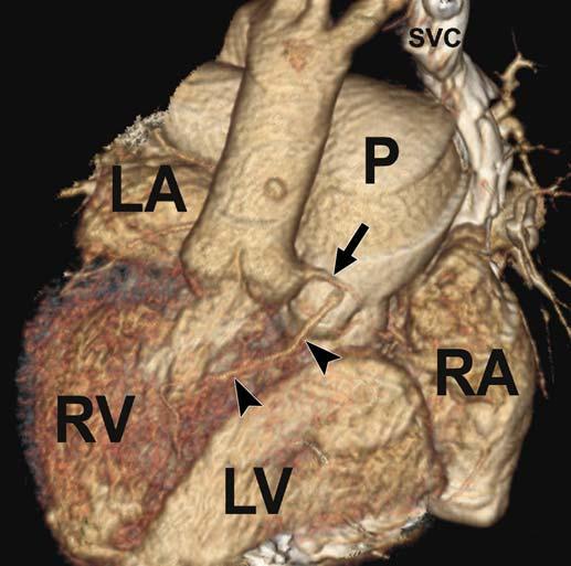 B, Axial image at level of cardiac chambers shows that morphologic left atrium (LA) is connected to a morphologic right ventricle (RV), distinguished by prominent trabeculations along its septal