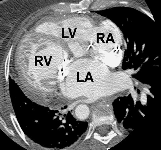 C, Reformatted oblique coronal image through outflow tract of posterior ventricle shows muscular infundibulum (arrows) separating inflow and outflow regions and confirming that posterior ventricle is