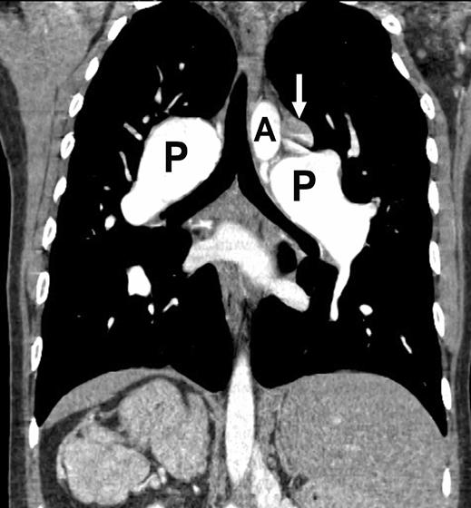 Dextrocardia in Adults the apex of an L-bulboventricular loop into the right hemithorax [25]. Situs inversus, D-loop ventricles, and D-TGA are a discordant D-bulboventricular loop.