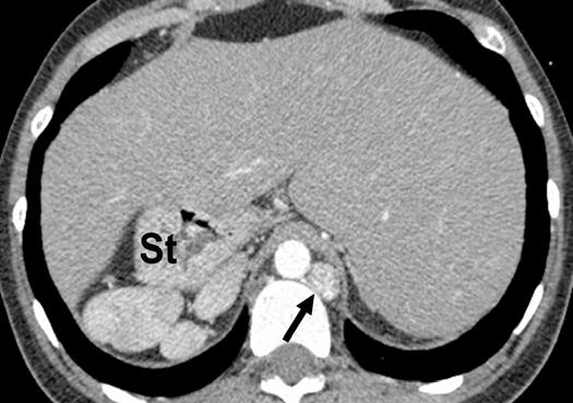 Failure of the terminal shift of the apex of the D- bulboventricular loop into the left hemithorax during embryologic development can result in dextrocardia.