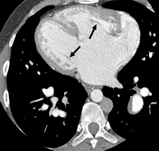 Associated cardiac anomalies, such as ventricular septal defect, pulmonary outflow obstruction, and systemic atrioventricular valve dysfunction, are common in all forms of congenitally corrected TGA