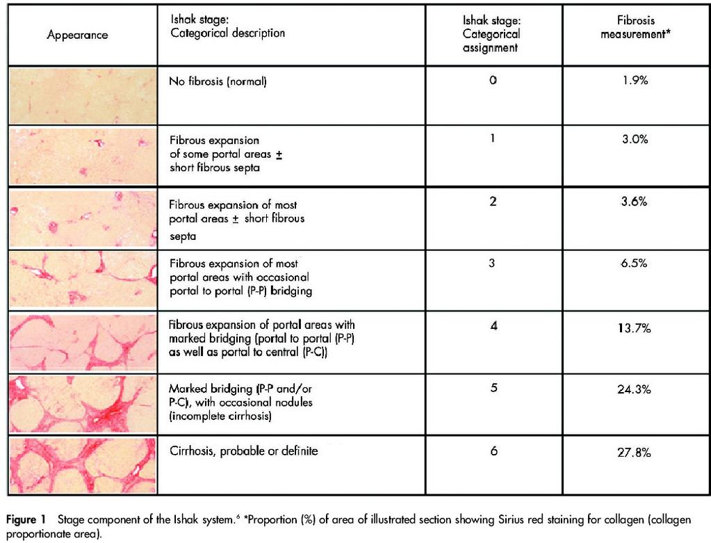 Correlation between area of fibrosis / Metavir stage Correlation between area of fibrosis /Ishak stage Area of fibrosis (%) METAVIR STAGE F0 F1 F2 F3 F4