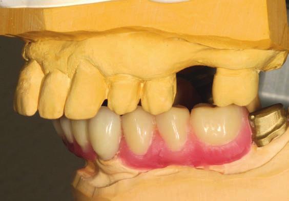 transmitted evenly. This minimises initial abrasion and ensures optimum integration into the abraded residual dentition of older people.