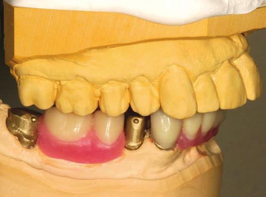This also facilitates setup of the teeth. Tooth base A wider tooth base allows maximum coverage of tertiary and implant structures.