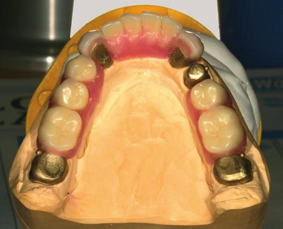 Selecting teeth is not easy for the dental technician; in most cases, the posterior teeth are too small and the cusp