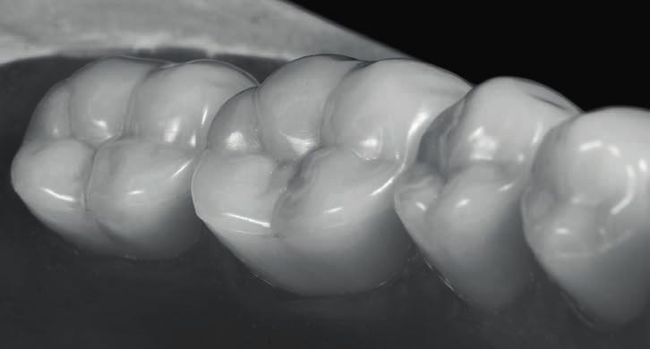 The new shape of posterior teeth can very easily used in hybrid prostheses to cover the substructure, regardless of