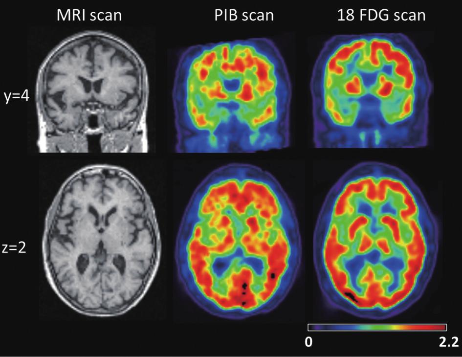 100 F. Caso et al. / Nonfluent/agrammatic PPA with in-vivo cortical amyloidosis and Pick s disease pathology Fig. 1. PIB and FDG-PET obtained at Year 5.