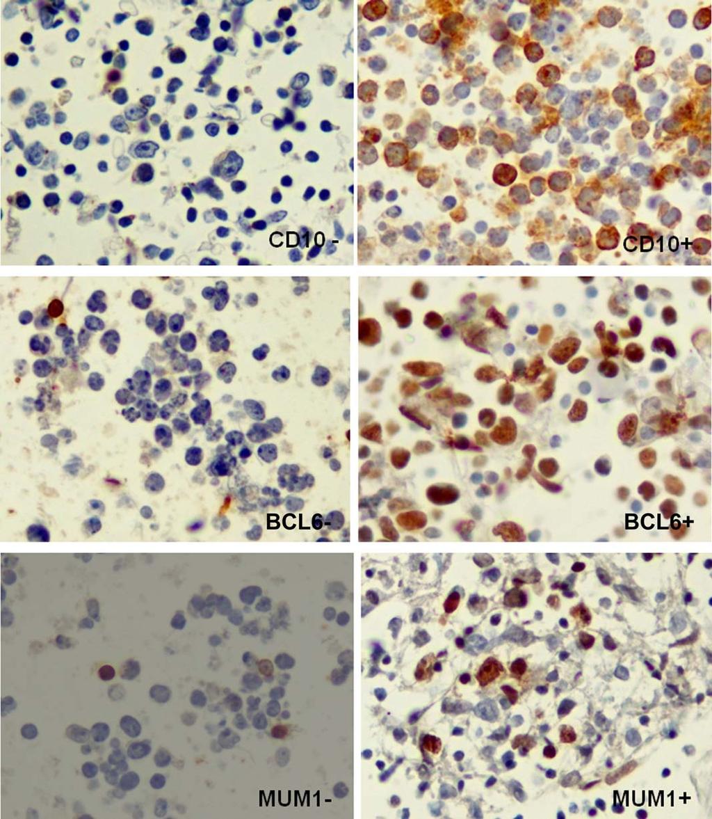 Figure 2. Immunostaining with CD10, B-cell lymphoma 6 (BCL6), and multiple myeloma oncogene 1 (MUM1) in diffuse large B-cell lymphoma cell blocks.