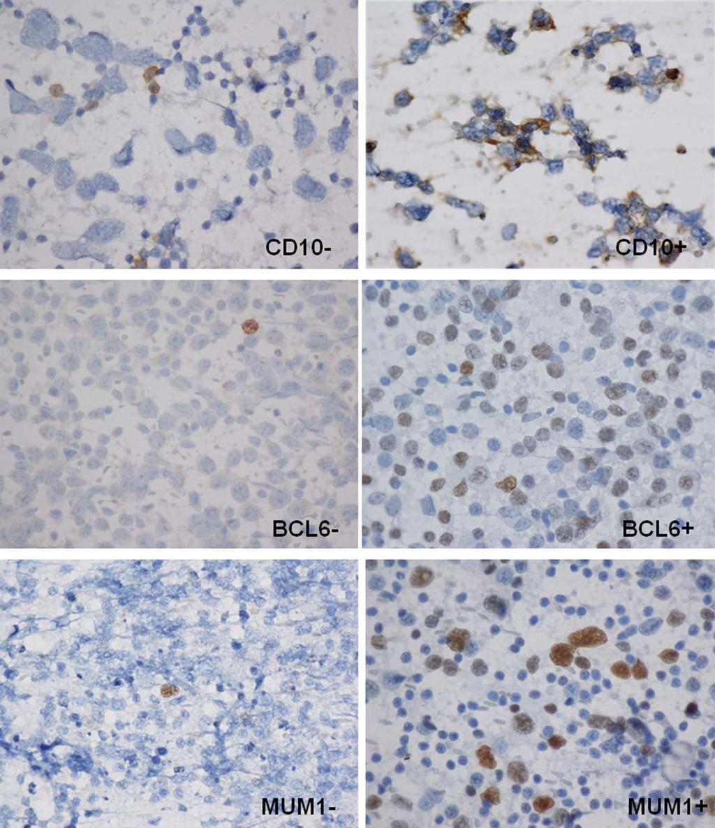 CD10, BCL6, and MUM1 in DLBCL/Cozzolino et al Figure 3. Immunostaining with CD10, B-cell lymphoma 6 (BCL6), and multiple myeloma oncogene 1 (MUM1) in diffuse large B-cell lymphoma conventional smears.