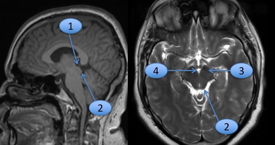 (both are more clear in sagittal radiographes) 3.Cerebral peduncle. 4.Interpeduncular cistern.