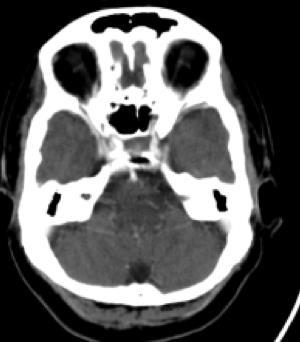 Petrous bone CT+ Pons: CT+ Basilar artery Radiological Features: Basilar artery (comes from