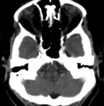 2 3 P p P pons 1. 4th ventricle**. 2. basilar artery***. 3. middle cerebellar peduncle.