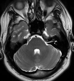 MRI Axial T2WI ***Black spot. ^ To know how to diffrenciate this image of M.O.