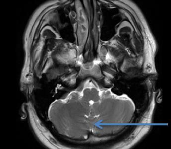 hemispheres) Cerebellar Tonsil MRI Sagittal T1WI MRI Axial T2WI