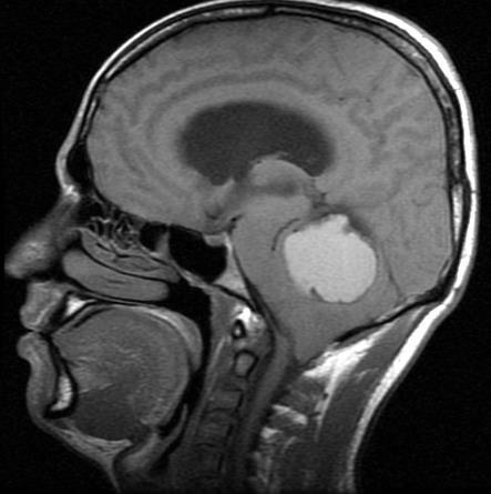 tumor Axial MRI