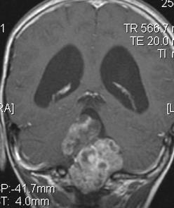 MRI T2W1 Coronal
