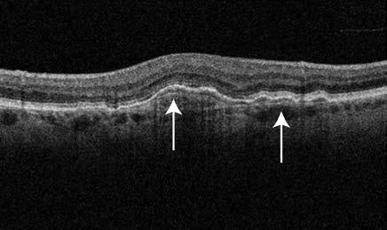 4 danish medical JOURNAL Dan Med J 64/2 February 217 Optical coherence tomography of the retina from an 87-year-old man.
