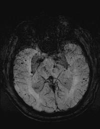 Axial SWI image. Axial SWI image. MeSH Intracranial Hemorrhage, Hypertensive [C10.228.140.300.