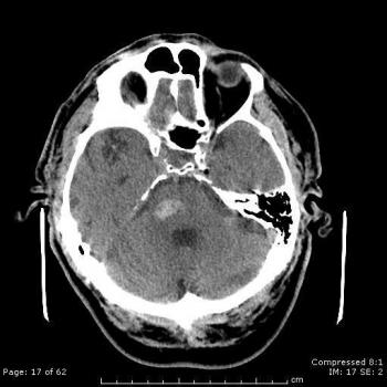 Macrohaemorrhage on the right