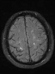 Figure 6 Axial FLAIR images Bilateral periventricular hyperintensities due to ischaemic