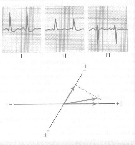 Figure: left axis deviation caused