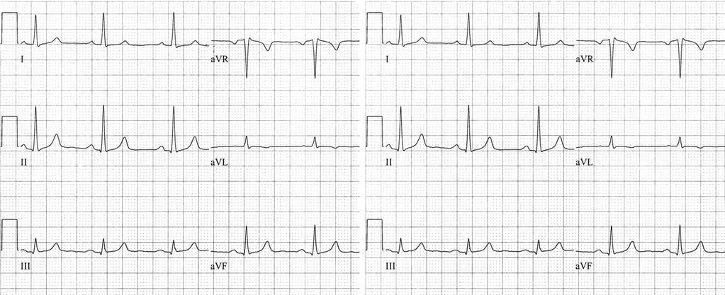 Step 1 Step 2 Normal quadrant Fig. 2.9 Determining the QRS axis. Step One: Examine leads I and avf. Result: Both I and avf are positive. Interpretation: Axis in normal quadrant.