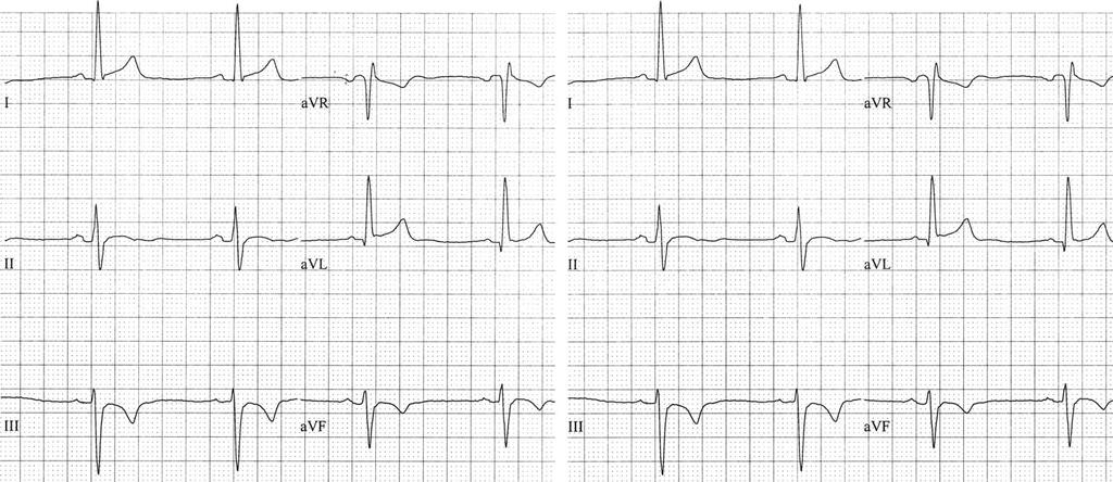 Step 1 Step 2 Left axis deviation Fig. 2.10 Determining the QRS axis. Step One: Examine leads I and avf. Result: Lead I is positive; lead avf is negative.