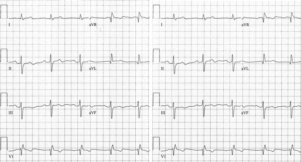Step 1 Step 2 avr Left axis deviation Fig. 2.12 Determining the QRS axis. Step One: Look at leads I and avf. Result: Using the first 0.08 s of the QRS complex (since the total duration is 0.