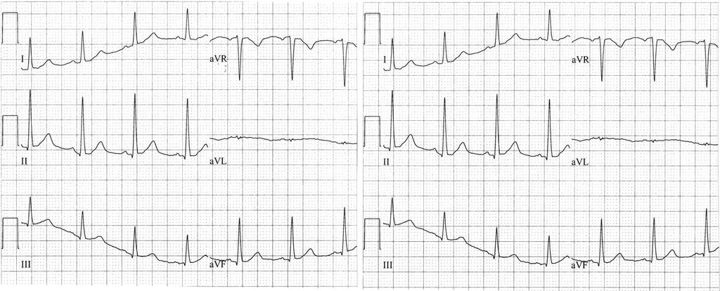 avl Step 1 Normal quadrant Fig. 2.3 Step One: Examine leads I and avf. Result: Both I and avf are positive. Interpretation: Axis in normal quadrant (0 to +90 ).