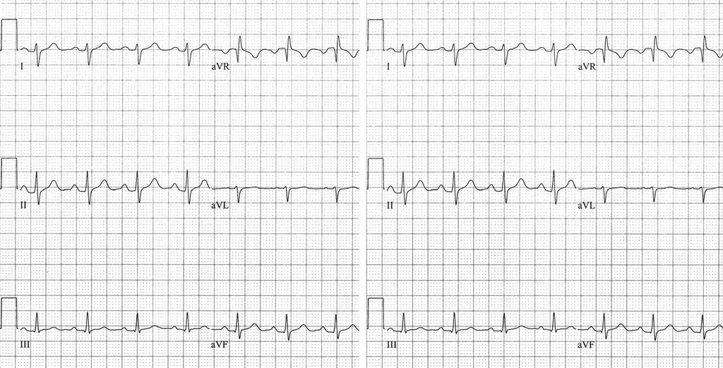 avr Step 1 Right axis deviation Fig. 2.5 Determining the QRS axis. Step One: Examine leads I and avf. Result: Lead I is negative; avf is positive.