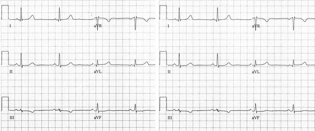 Step 1 Step 2 Normal quadrant III Fig. 2.6 Determining the QRS axis. Step One: Examine leads I and avf. Result: Both I and avf are positive. Interpretation: Axis in normal quadrant.