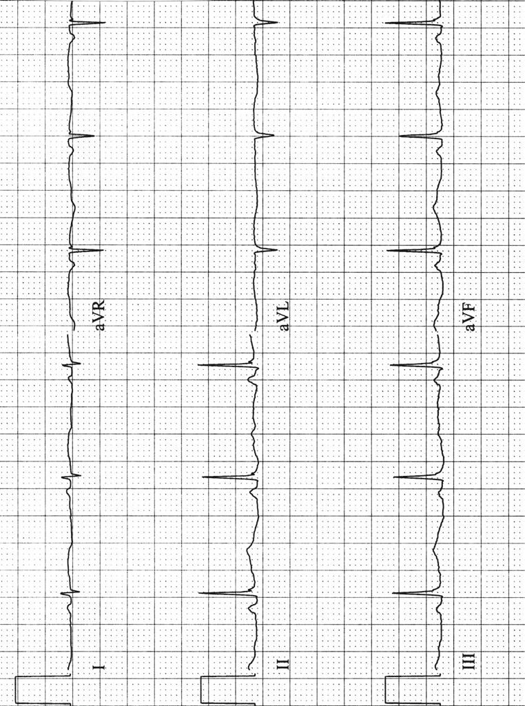 2 Axis 27 I Fig. 2.8 Determining the QRS axis. Step One: Examine leads I and avf.