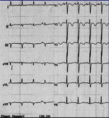 T3 20% Clockwise rotation: 10-56% RBBB (complete or incomplete): 6-67% AF or AFlutter: 0-35% No ECG changes: 20-24% These changes are frequently transient resulting in a wide range of incidence 25 26