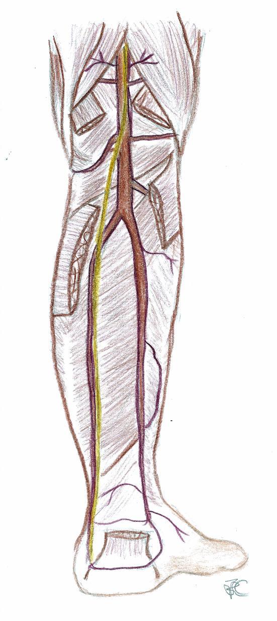 Popliteal Artery Branches Lateral superior genicular artery Medial superior genicular artery Sural artery Medial inferior