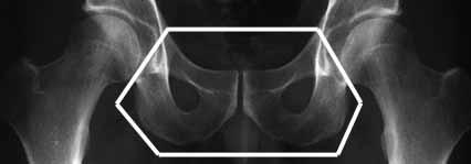 Bone Scan and MRI are Sensitive MRI