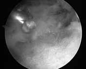 Failure to address bony impingement lesions of the hip are key factors in unsuccessful hip arthroscopy