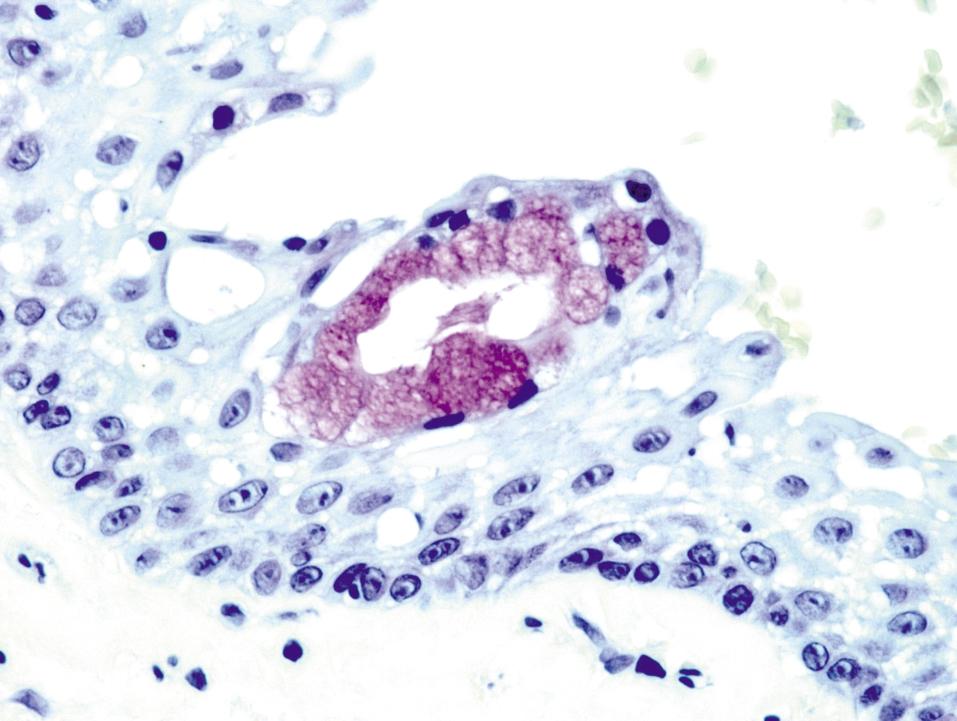 79 Fig. 1 Mucous and ciliated cells in epithelial linings of radicular cysts.