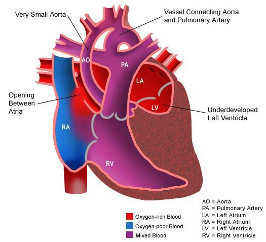 Complex Single Ventricular Defects Hypoplastic Left Heart Syndrome (HLHS) of all CHD cases Most common cause of from CHD in 1st month of life Description: o ventricle underdevelopment (left