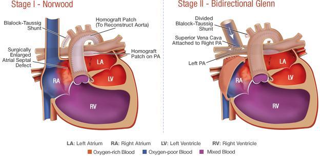 amounts of blood flows through VSDright ventricle pulmonary arterylungs (or PDA) Tricuspid Atresia: Medical Management Prostaglandin E1 may be used to keep PDA open until surgical repair Frequent