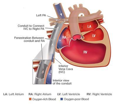 Stage III: Fontan Procedure 2-4 years of age o End to end anastomosis of inferior vena cava to right pulmonary artery through Allows oxygen poor blood to be sent to lungs o Tube placed through right