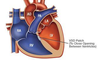 Septal Defect: Abnormal opening or hole that allows blood to pass from the RV to the LV