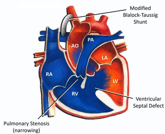 from the right side of the heart to the lungs 3. Overriding : aorta lies directly over the VSD 4.