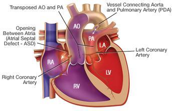 positions Aorta carrying oxygen blood to body o Pulmonary artery carrying oxygen blood to lungs ASD, VSD, & PDA necessary for survival Moderate to severe cyanosis TGA: Medical &