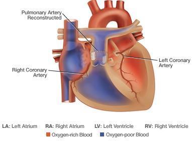 Surgical o Arterial Switch Aorta and pulmonary artery divided Aorta