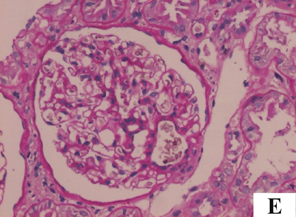 (a) Glomerular mesangial cells proliferation accompanied with cellular crescents (arrow showed). (HE staining, 2).