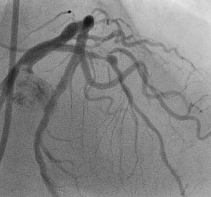 2 stents approach when