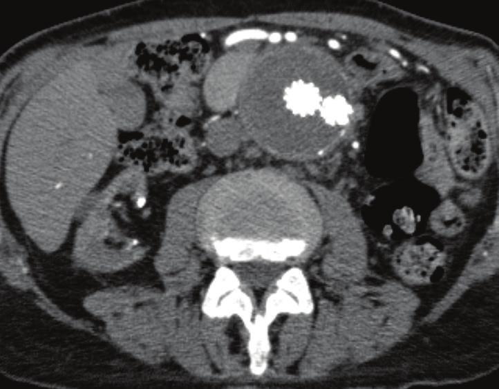 2 Case Reports in Radiology Figure 1: 12-month follow-up CT scan indicating complete exclusion of the aneurysm with sac shrinkage after the initial procedure.