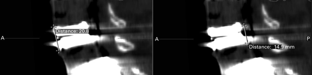 2b CT scans showing measurement of the angle of lordosis a) before and b) after instrumentation. The pre-operative mean intervertebral disc height at levels L3-4, L4- and L-S1 was 7.8 mm (SD 2.), 8.
